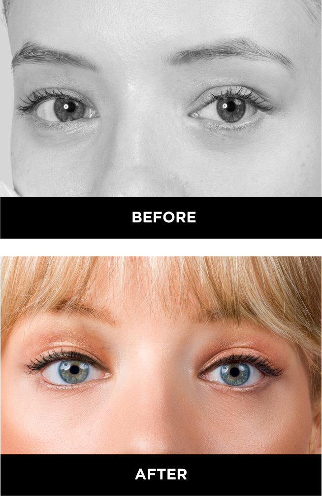 wide set eyes before and after